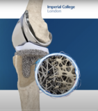 OSSTEC’s Bone-Like 3D Printed Implants Get £2.5M to Target US Market – 3DPrint.com